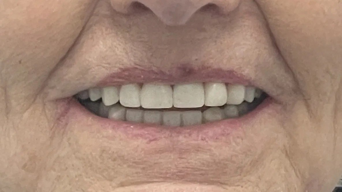 imgi_8_ImplantsCrown-after-1-1